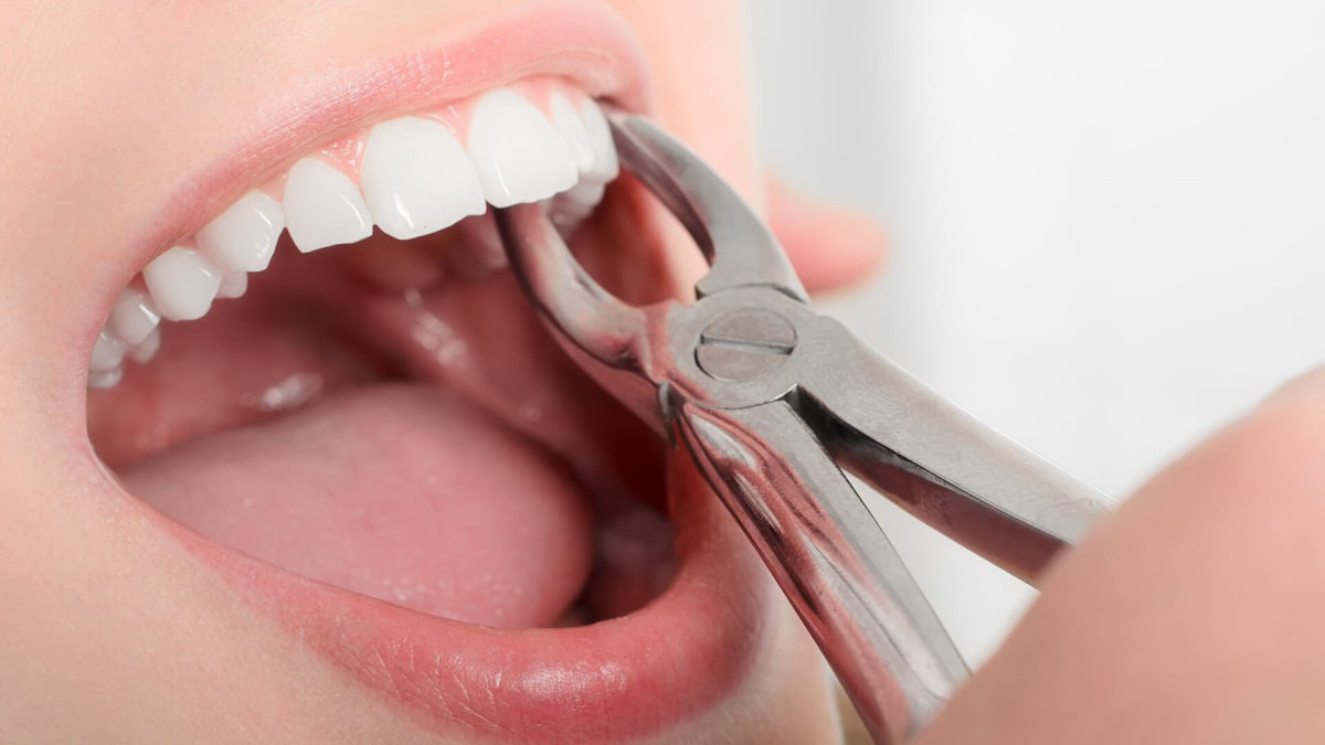 Know All About Singapore Dental Wisdom Tooth Extraction