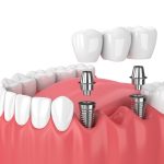 Harnessing the Power of 3D Printing for Custom Dental Implants