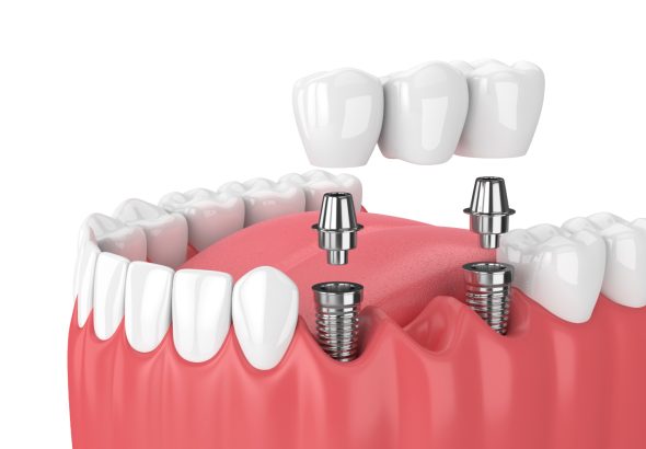 Harnessing the Power of 3D Printing for Custom Dental Implants