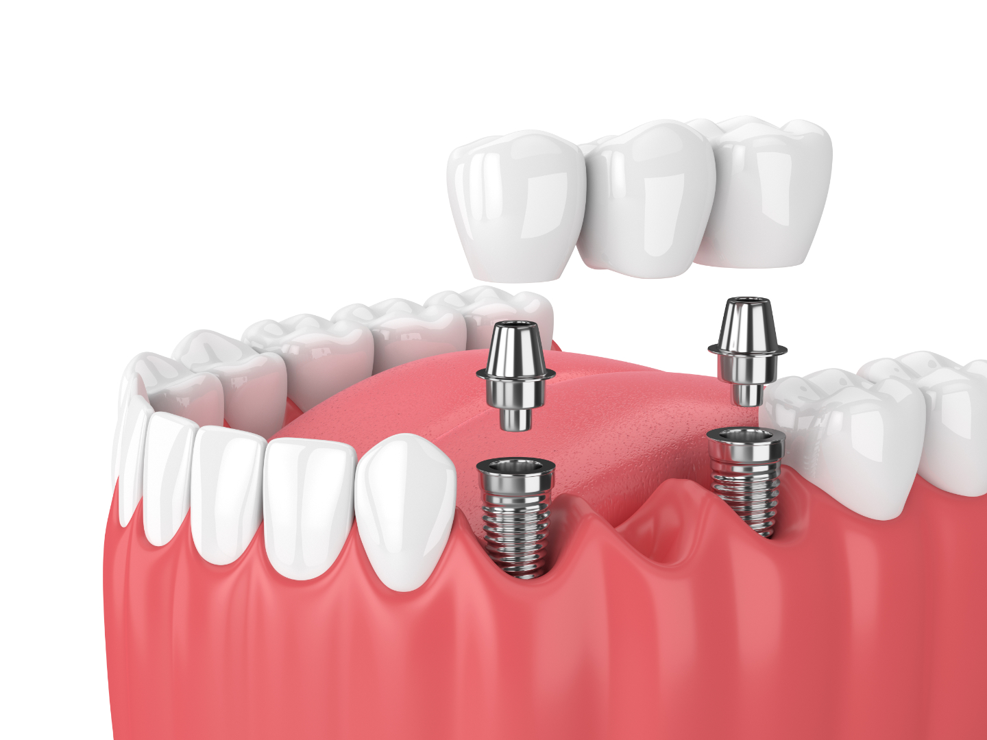 Harnessing the Power of 3D Printing for Custom Dental Implants