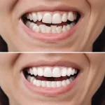 The Science Behind How Composite Resin Bonds to Tooth Enamel