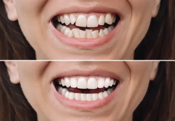 The Science Behind How Composite Resin Bonds to Tooth Enamel
