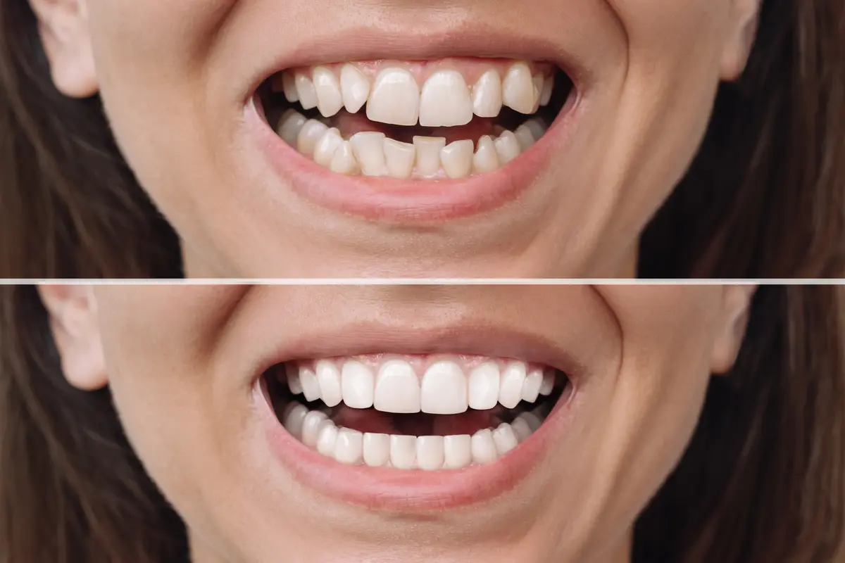 The Science Behind How Composite Resin Bonds to Tooth Enamel